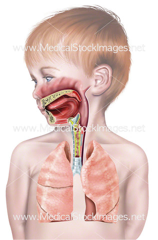 Upper Airway of Young Child with Mucus in the Larynx