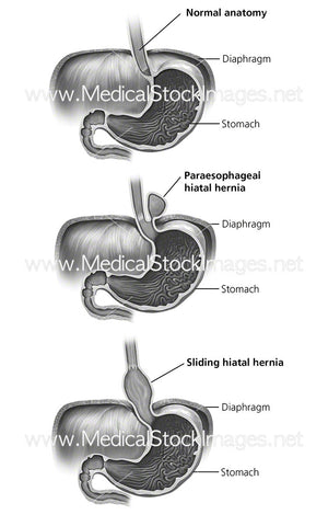 Types of Hiatal Hernia