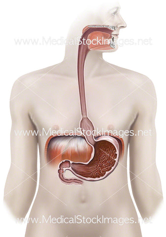 Sliding Hiatal Hernia