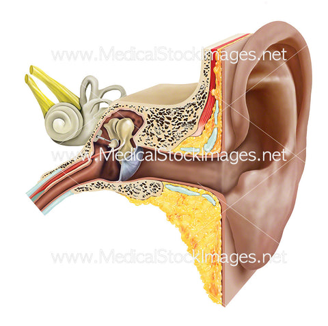 Stapedectomy of the Stapes of the Ear