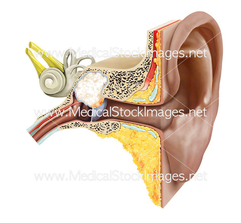 Cholesteatoma of the Middle Ear