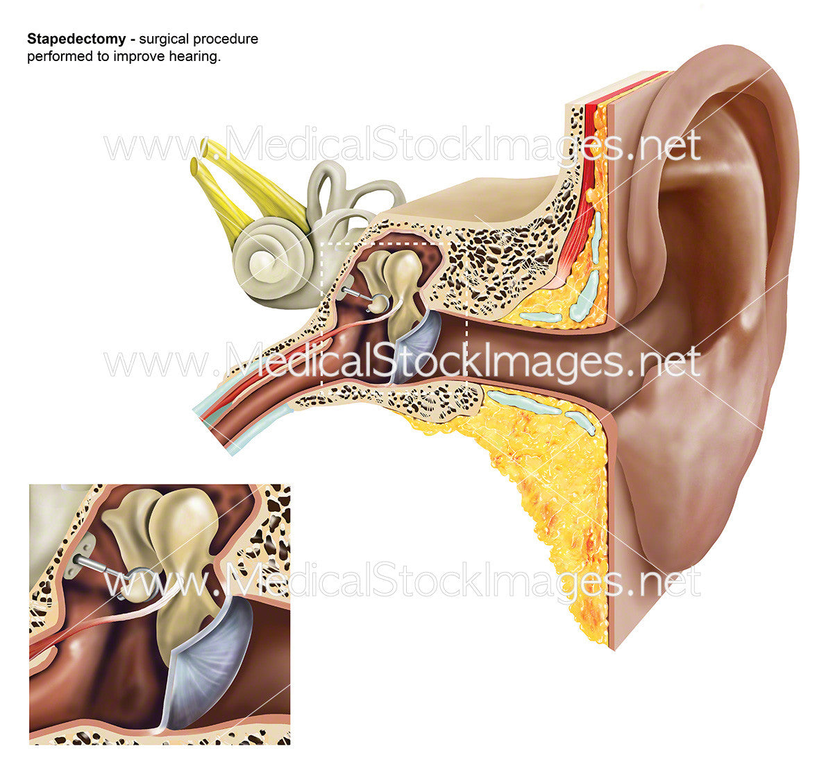 Stapedectomy of the Stapes of the Ear - Labelled – Medical Stock