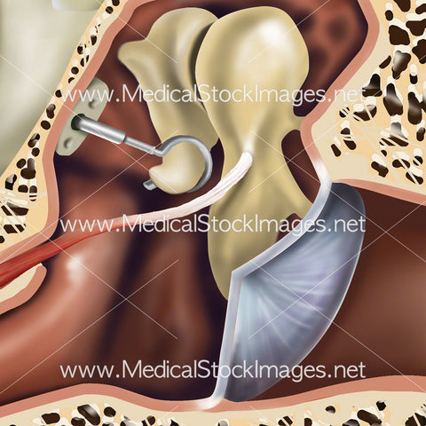 Surgical Procedure - Stapedectomy