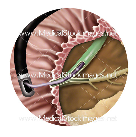 Endoscopic Retrograde Cholangiopancreatography or ERCP