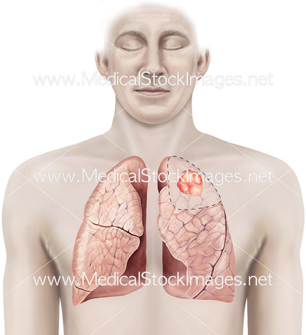 Wedge Lung Surgery