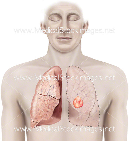 Pneumonectomy – Lung Surgery
