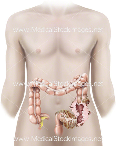 Diverticular Disease