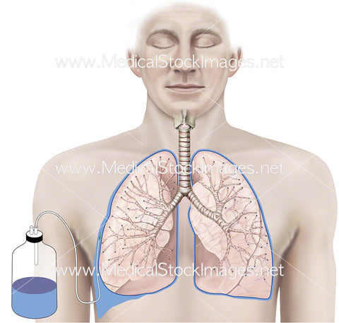 Chest Drain