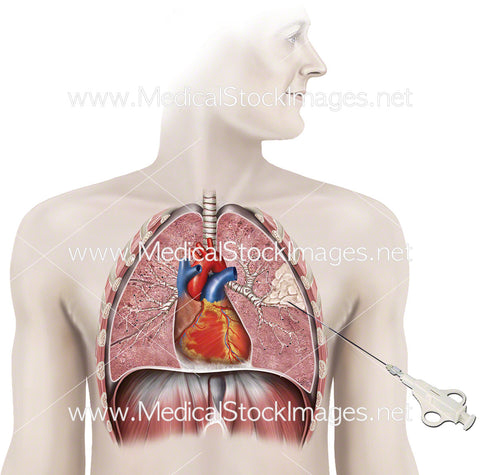 Procedure for Lung Biopsy