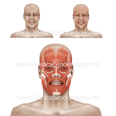 Blepharospasm