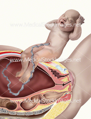 Caesarean Section