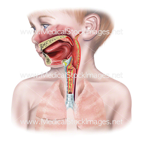 Upper Airway of Child With Bronchiolitis