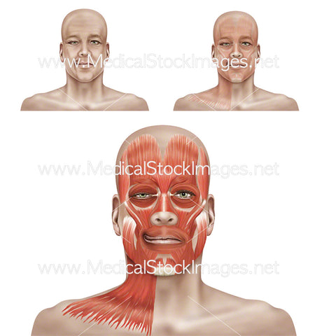 Hemifacial Spasm