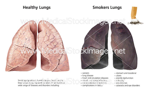 Healthy Lungs and Smoker’s Lungs - Labelled