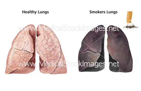 Healthy Lungs and Smoker’s Lungs