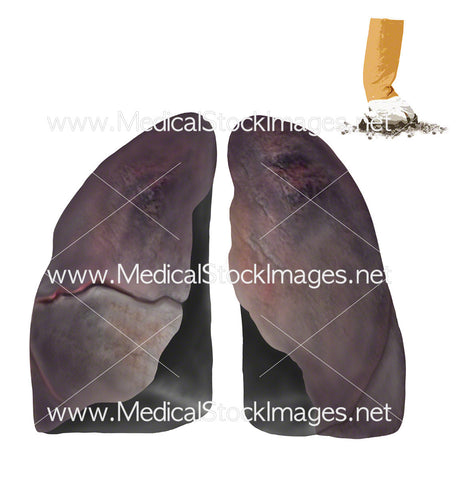Lungs of a Smoker