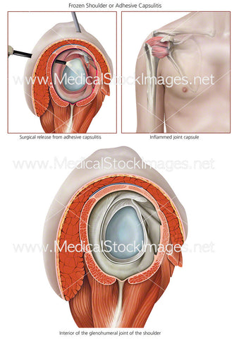 Frozen Shoulder or Adhesive Capsulitis - Labelled