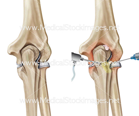 Elbow Surgery to Remove an Intra-Articular Loose Body