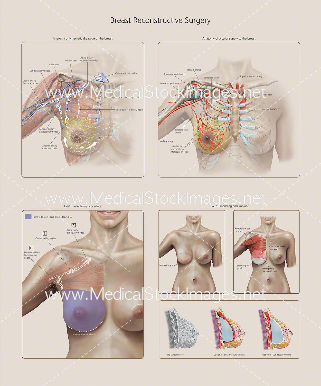 Chart of Breast Reconstructive Surgery – Medical Stock Images Company