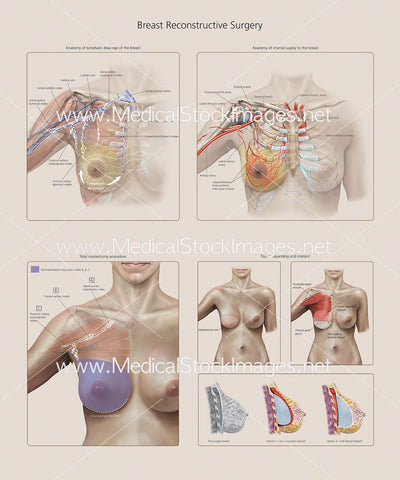 Chart of Breast Reconstructive Surgery
