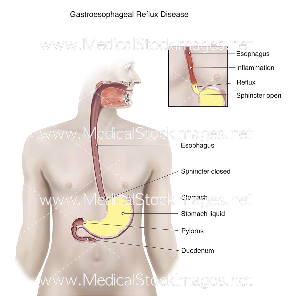 Reflü Gastroesophageal Reflux Disease - Labelled – Medical Stock Images Company