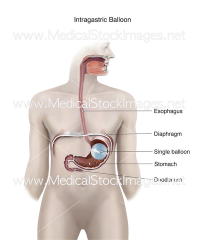 Intragastric Balloon - Labelled