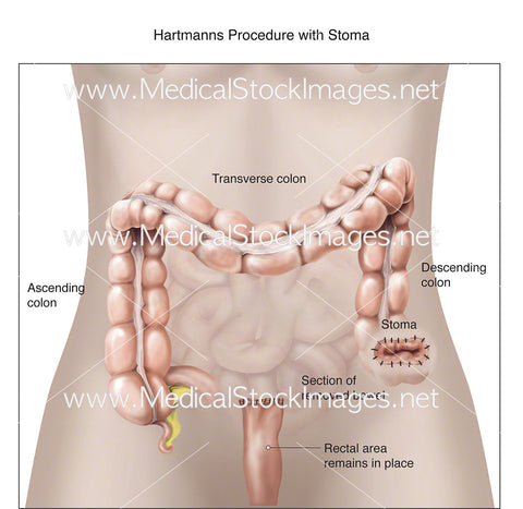 Hartmanns Procedure with Stoma - Labelled
