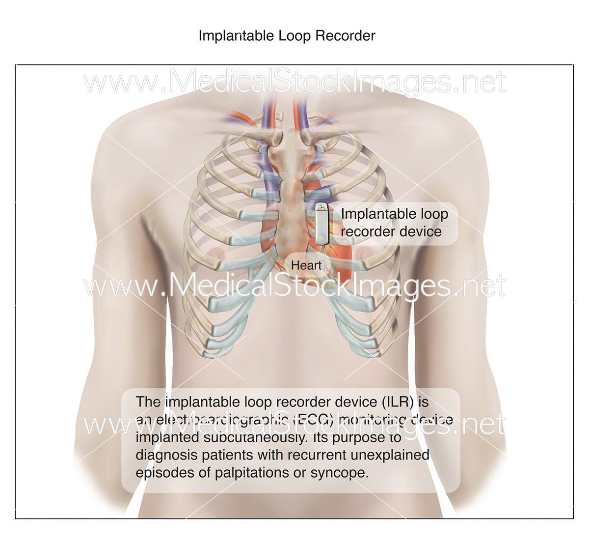 Veterinary Loop Recorder Implantable Loop Recorder – Medical Stock Images Company