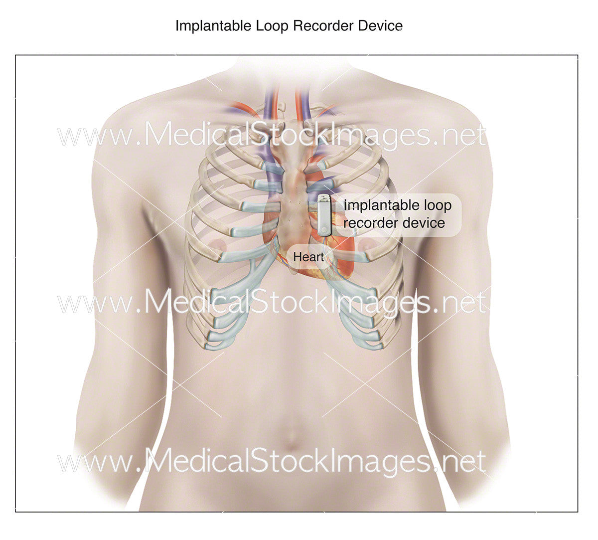 Dermloop Device Heart Loop