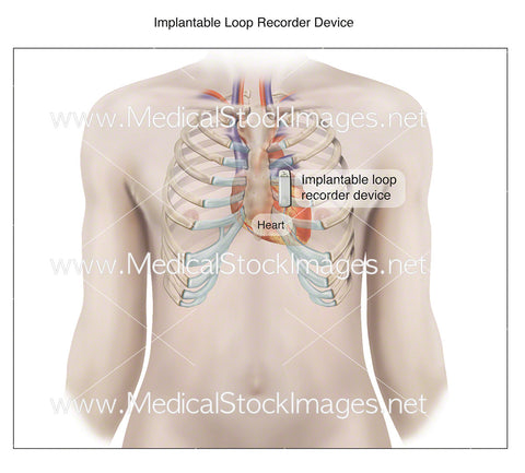 Implantable Loop Recorder Device for the Heart