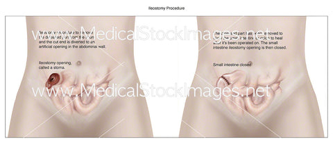 Ileostomy Procedure - Labelled