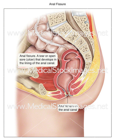 Anal Fissure - Labelled