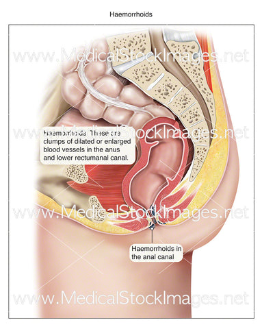 Haemorrhoids - Labelled