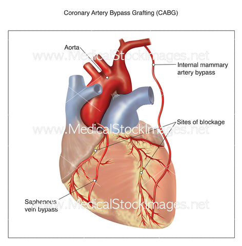 Coronary Artery Bypass Grafting (CABG)