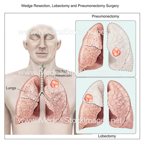 Wedge Resection, Lobectomy and Pneumonectomy Surgery