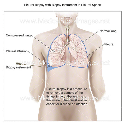 Pleural Biopsy with Instrument in Pleural Space