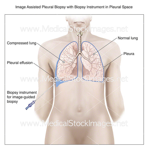 Image Assisted Pleural Biopsy with Instrument in Pleural Space