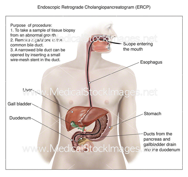 Endoscopic Retrograde Cholangiopancreatogram - Labelled – Medical Stock ...