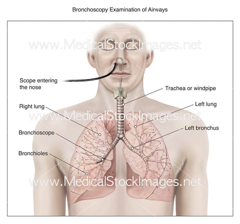 Bronchoscopy Examination of Airways