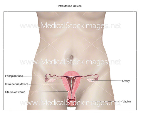 Intrauterine Device - Labelled