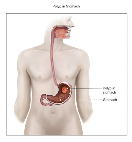 Polyp in Stomach