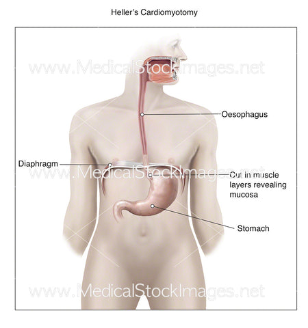 Heller's Cardiomyotomy