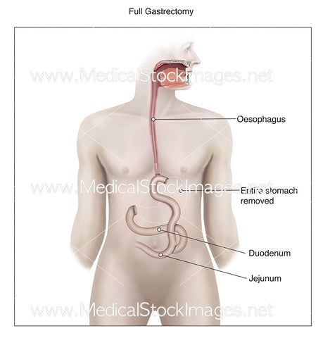 Total Gastrectomy - Labelled