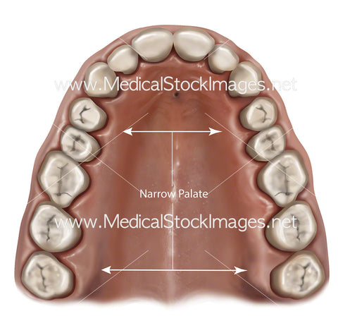 Narrow Palate