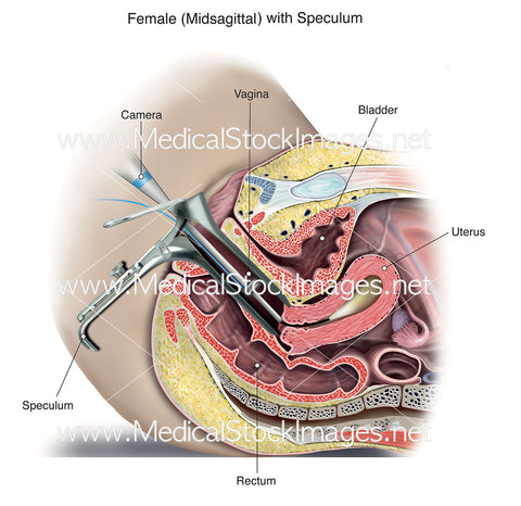 Female with Speculum - Labelled