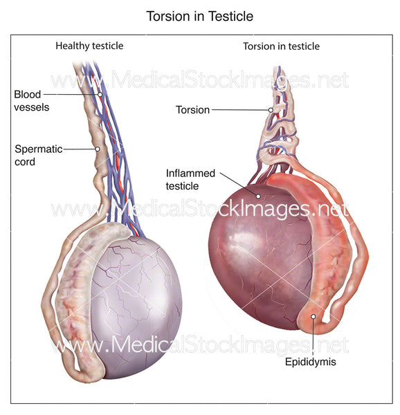 Torsion in Testicle - Labelled – Medical Stock Images Company