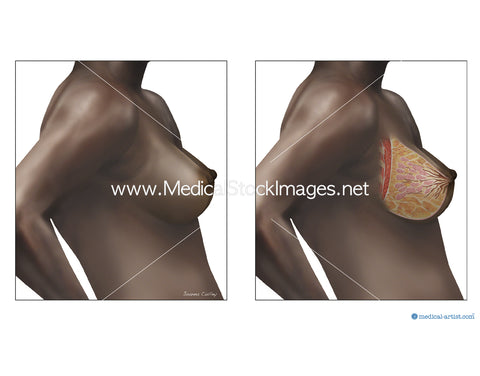 Woman breast implant cross section. Comparison diagram, under and over  pectoral muscle Stock Photo - Alamy
