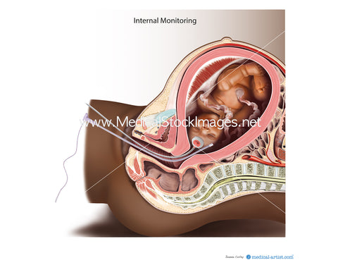 Internal Fetus Monitoring during Pregnancy