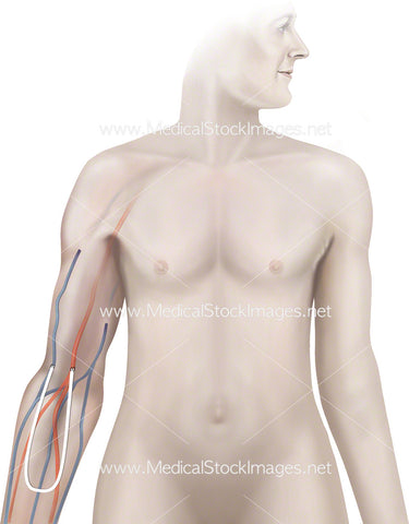 Fistula Ligation with Arteriovenous Graft