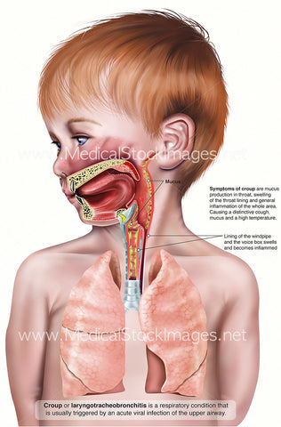 Young Boy with Croup Showing Respiratory Tract in Cross-Section (Labelled)